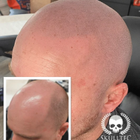 Scalp Micropigmentation (SMP) For Men in London and UK