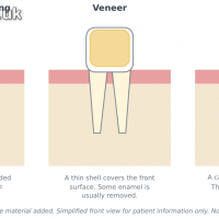 Compare Veneers, Crowns and Bonding for Your Smile in Bristol
