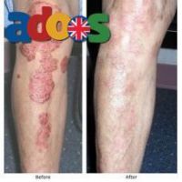 AROGYAM PURE HERBS KIT FOR PSORIASIS