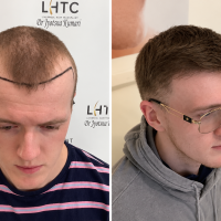 Natural Looking FUE Hair Transplant Results Across the UK