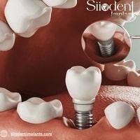 Complete Dental Implants: The Comprehensive Solution 