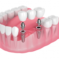 Dental implants Harley St