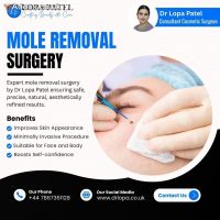 Mole Removal Surgery in UK by Dr Lopa Patel