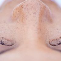 Laser treatment for face pigmentation