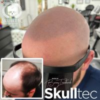 Best Scalp Micropigmentation Cost in Kent