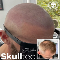 Scalp Micropigmentation Cost and Price Glasgow
