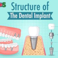 Dental implants placement: A Technique of Modern Dentistry 