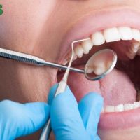What is Scaling and Root Planing Treatment ?