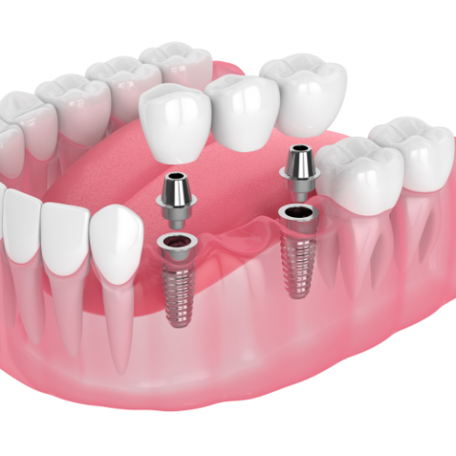 Dental implants Harley St
