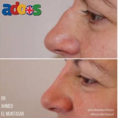 Non Surgical Rhinoplasty London